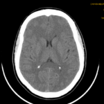 CT CISTERNOGRAPHY