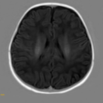MRI BRAIN DIFFUSSION