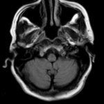MRI BRAIN WITH MASTOIDS