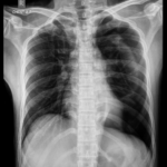 X-RAY CHEST(AP)