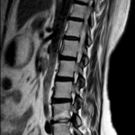 MRI DORSAL SPINE