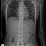 X-RAY DORSAL SPINE(AP & LAT)