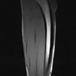MRI FORE ARM