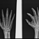 X-RAY HAND (AP & OBL)