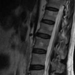 MRI LUMBAR SPINE WITH ANY CUTS