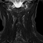 MRA NECK
