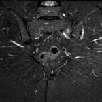 MRI SI JOINTS