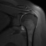 MRI SHOULDER