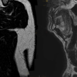 MRI SHOULDER & C SPINE CUTS