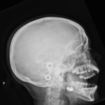 X-RAY TMJOINT (TEMPEROMANDIBULAR JOINT)