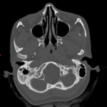 CT TEMPORAL / MASTOIDS
