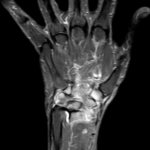 MRI WRIST