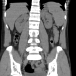CT UPPER ABDOMEN