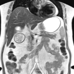 CT WHOLE ABDOMEN AND RECTAL CONTRAST