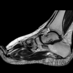 MRI ANKLE