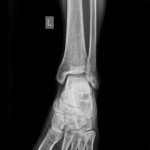X-RAY ANKLE (AP & LAT)