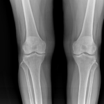 X-RAY BOTH KNEE (SKYLINE / SUNRISE VIEW)