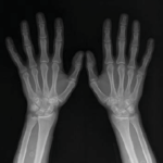 X-RAY BOTH WRIST (AP & LAT)