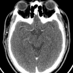 CT BRAIN ANGIO WITH VENOGRAM