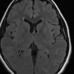 MRI BRAIN