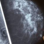 X- RAY MAMMOGRAM