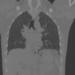 HRCT CHEST