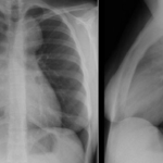 X-RAY CHEST(PA & LAT)