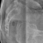 X-RAY COCCYX/SACRUM