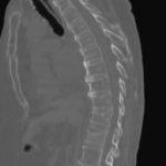 CT DORSAL SPINE