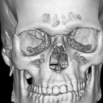 CT FACIAL BONES PLAIN AND CON