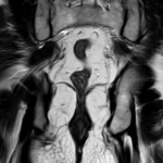 MRI FISTULOGRAM