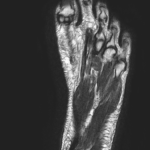 MRI FOOT