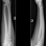 X-RAY FORE ARM (AP & LAT)