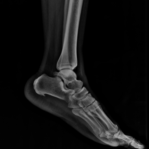 Ankle x-rays - Don't Forget the Bubbles