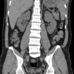 CT KUB TRIPHASIC