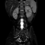 MRI UPPER ABDOMEN