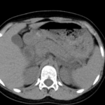 CT LIVER TRIPHASIC