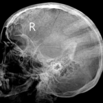 X-RAY BOTH MASTOIDS