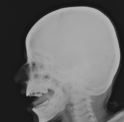 nasal bone x ray anatomy