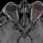 MRI ORBITS