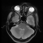 MRI BRAIN WITH ORBIT CUTS