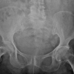 X-RAY PALVIS WITH BOTH HIPS