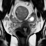 MRI PELVIS