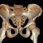 CT 3D PELVIS