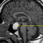 MRI PITUITARY