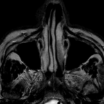 MRI PNS