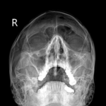 X-RAY PNS (PARANASAL SINUS)