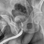 X-RAY AUG / RGU (RETROGRADE URETHROGRAM)