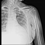 X-RAY SHOULDER (AP & LAT)