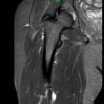 MRI HIP JOINT